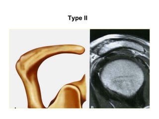 Type II
 