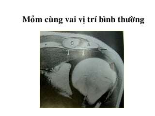 Moûm cuøng vai vò trí bình thöôøng
 