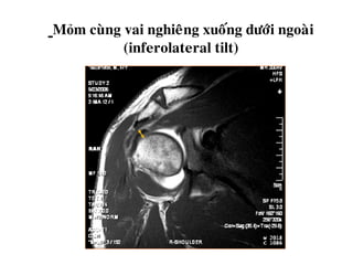 Mỏm cuøng vai nghieâng xuoáng döôùi ngoaøi
(inferolateral tilt)
 