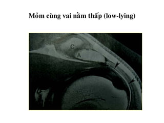 Moûm cuøng vai naèm thaáp (low-lying)
 