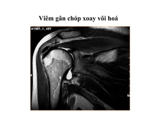 Viêm gân chóp xoay vôi hoá
 