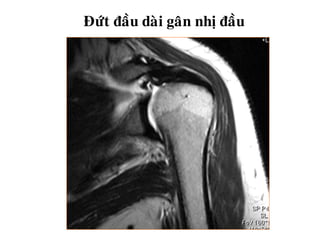 Ñöùt ñaàu daøi gaân nhò ñaàu
 