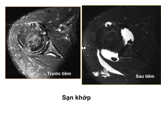 Trước tiêm
Sau tiêm
Sạn khớp
 