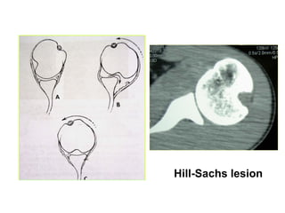 Hill-Sachs lesion
 