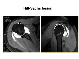 Hill-Sachs lesion
 