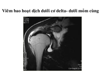 Vieâm bao hoaït dòch döôùi cô delta- döôùi moûm cuøng
 