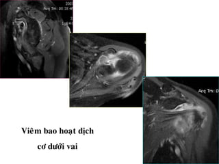 Vieâm bao hoaït dòch
cô döôùi vai
 