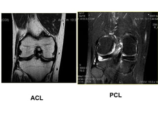 ACL PCL
 