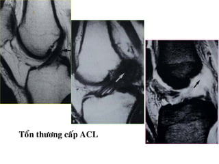Toån thöông caáp ACL
 