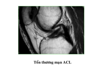 Toån thöông maïn ACL
 