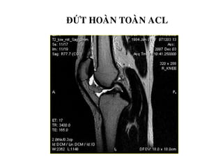ĐỨT HOAØN TOAØN ACL
 