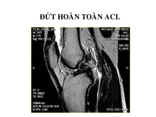 ĐỨT HOAØN TOAØN ACL
 