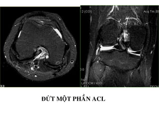 ĐỨT MOÄT PHAÀN ACL
 