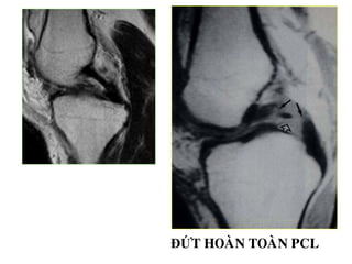 ĐỨT HOAØN TOAØN PCL
 