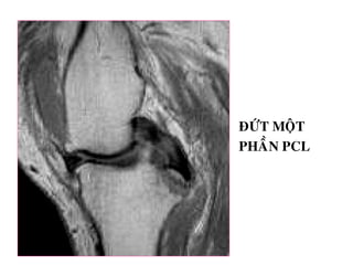 ÑÖÙT MOÄT
PHAÀN PCL
 