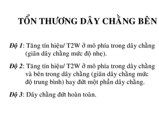 TOÅN THÖÔNG DAÂY CHAÈNG BEÂN
Ñoä 1: Taêng tín hieäu/ T2W ôû moâ phía trong daây chaèng
(giaõn daây chaèng möùc ñoä nheï).
Ñoä 2: Taêng tín hieäu/ T2W ôû moâ phía trong daây chaèng
vaø beân trong daây chaèng (giaõn daây chaèng möùc
ñoä trung bình) hay ñöùt moät phaàn daây chaèng.
Ñoä 3: Daây chaèng ñöùt hoaøn toaøn.
 