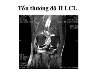 Toån thöông ñoä II LCL
 