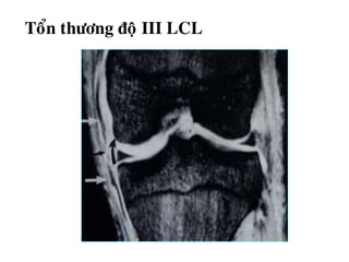 Toån thöông ñoä III LCL
 