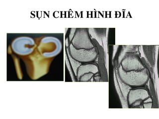 SUÏN CHEÂM HÌNH ÑÓA
 