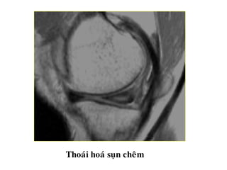Thoaùi hoaù suïn cheâm
 