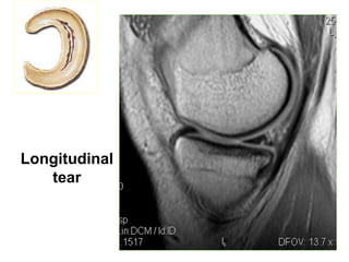 Longitudinal
tear
 