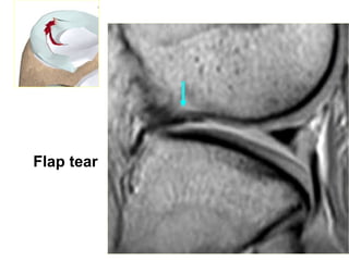 Flap tear
 