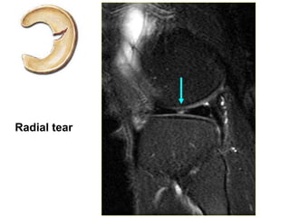 Radial tear
 