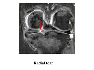 Radial tear
 