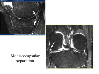 Meniscocapsular
separation
 