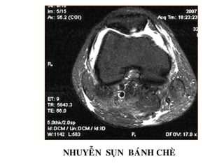 NHUYEÃN SUÏN BAÙNH CHEØ
 