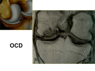 OCD
 