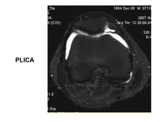 PLICA
 