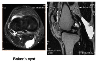 Baker’s cyst
 