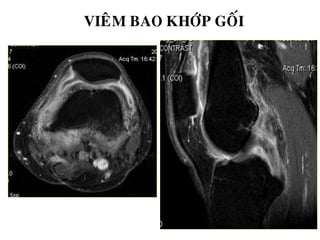 VIEÂM BAO KHÔÙP GOÁI
 