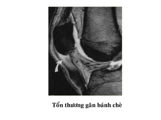 Toån thöông gaân baùnh cheø
 