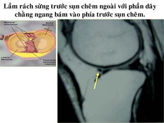 Laàm raùch söøng tröôùc suïn cheâm ngoaøi vôùi phaàn daây
chaèng ngang baùm vaøo phía tröôùc suïn cheâm.
 