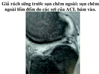Giaû raùch söøng tröôùc suïn cheâm ngoaøi: suïn cheâm
ngoaøi loám ñoám do caùc sôïi cuûa ACL baùm vaøo.
 