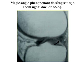 Magic-angle phenonenon: do söøng sau suïn
cheâm ngoaøi doác leân 55 ñoä.
 