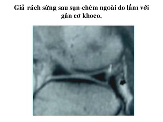 Giaû raùch söøng sau suïn cheâm ngoaøi do laàm vôùi
gaân cô khoeo.
 