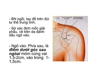 • - BN ngồi, tay để trên đùi
tư thế trung tính.
• - Sờ xác định mốc giải
phẫu, vẽ trên da đánh
dấu ngõ vào.
• - Ngõ vào: Phía sau, là
điểm dưới góc sau
ngòai mỏm cùng vai
1,5-2cm, vào trong 1-
1,5cm.
 