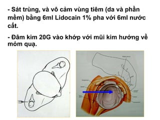 • - Sát trùng, và vô cảm vùng tiêm (da và phần
mềm) bằng 6ml Lidocain 1% pha với 6ml nước
cất.
• - Đâm kim 20G vào khớp với mũi kim hướng về
mỏm quạ.
 
