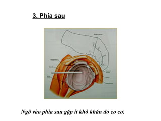 3. Phía sau
Ngõ vào phía sau gặp ít khó khăn do co cơ.
 