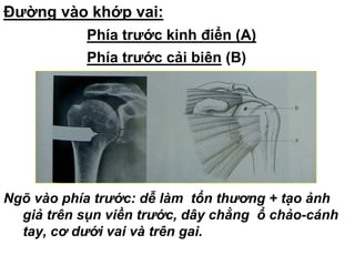 Đường vào khớp vai:
1.Phía trước kinh điển (A)
2.Phía trước cải biên (B)
Ngõ vào phía trước: dễ làm tổn thương + tạo ảnh
giả trên sụn viền trước, dây chằng ổ chảo-cánh
tay, cơ dưới vai và trên gai.
 