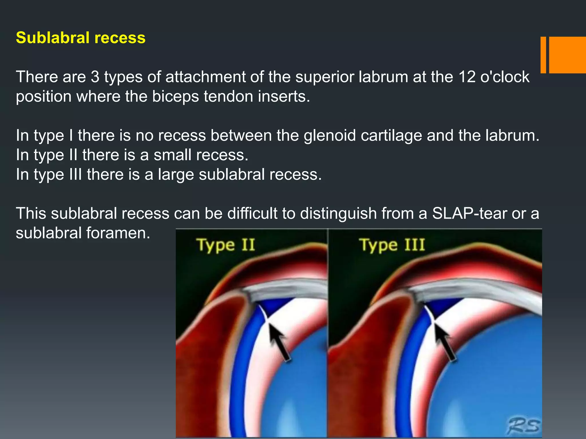Sublabral recess
There are 3 types of attachment of the superior labrum at the 12 o'clock
position where the biceps tendon inserts.
In type I there is no recess between the glenoid cartilage and the labrum.
In type II there is a small recess.
In type III there is a large sublabral recess.
This sublabral recess can be difficult to distinguish from a SLAP-tear or a
sublabral foramen.
 