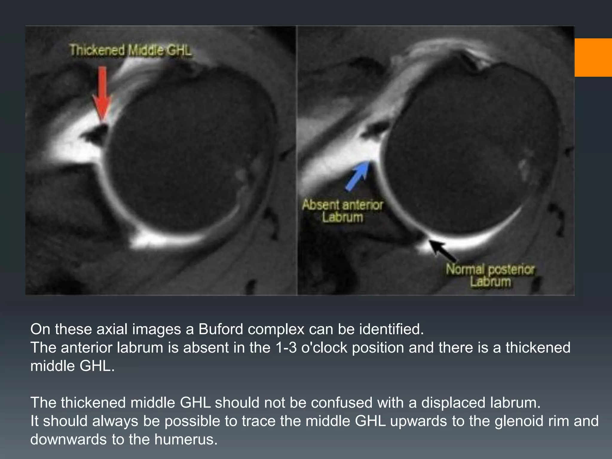 On these axial images a Buford complex can be identified.
The anterior labrum is absent in the 1-3 o'clock position and there is a thickened
middle GHL.
The thickened middle GHL should not be confused with a displaced labrum.
It should always be possible to trace the middle GHL upwards to the glenoid rim and
downwards to the humerus.
 