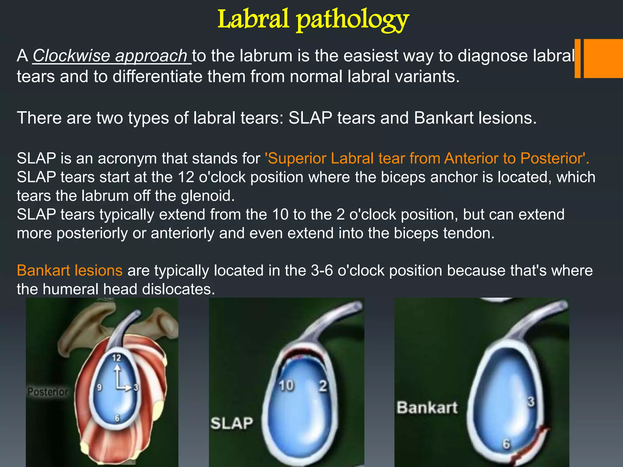 Labral pathology
A Clockwise approach to the labrum is the easiest way to diagnose labral
tears and to differentiate them from normal labral variants.
There are two types of labral tears: SLAP tears and Bankart lesions.
SLAP is an acronym that stands for 'Superior Labral tear from Anterior to Posterior'.
SLAP tears start at the 12 o'clock position where the biceps anchor is located, which
tears the labrum off the glenoid.
SLAP tears typically extend from the 10 to the 2 o'clock position, but can extend
more posteriorly or anteriorly and even extend into the biceps tendon.
Bankart lesions are typically located in the 3-6 o'clock position because that's where
the humeral head dislocates.
 