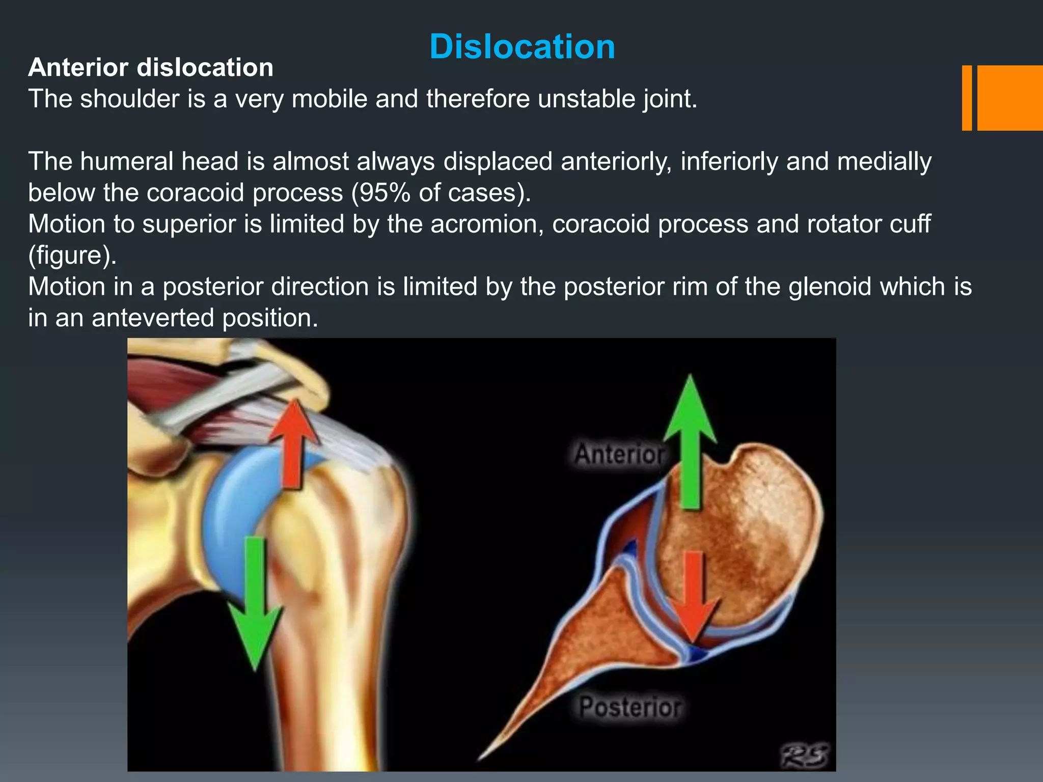 Dislocation
Anterior dislocation
The shoulder is a very mobile and therefore unstable joint.
The humeral head is almost always displaced anteriorly, inferiorly and medially
below the coracoid process (95% of cases).
Motion to superior is limited by the acromion, coracoid process and rotator cuff
(figure).
Motion in a posterior direction is limited by the posterior rim of the glenoid which is
in an anteverted position.
 