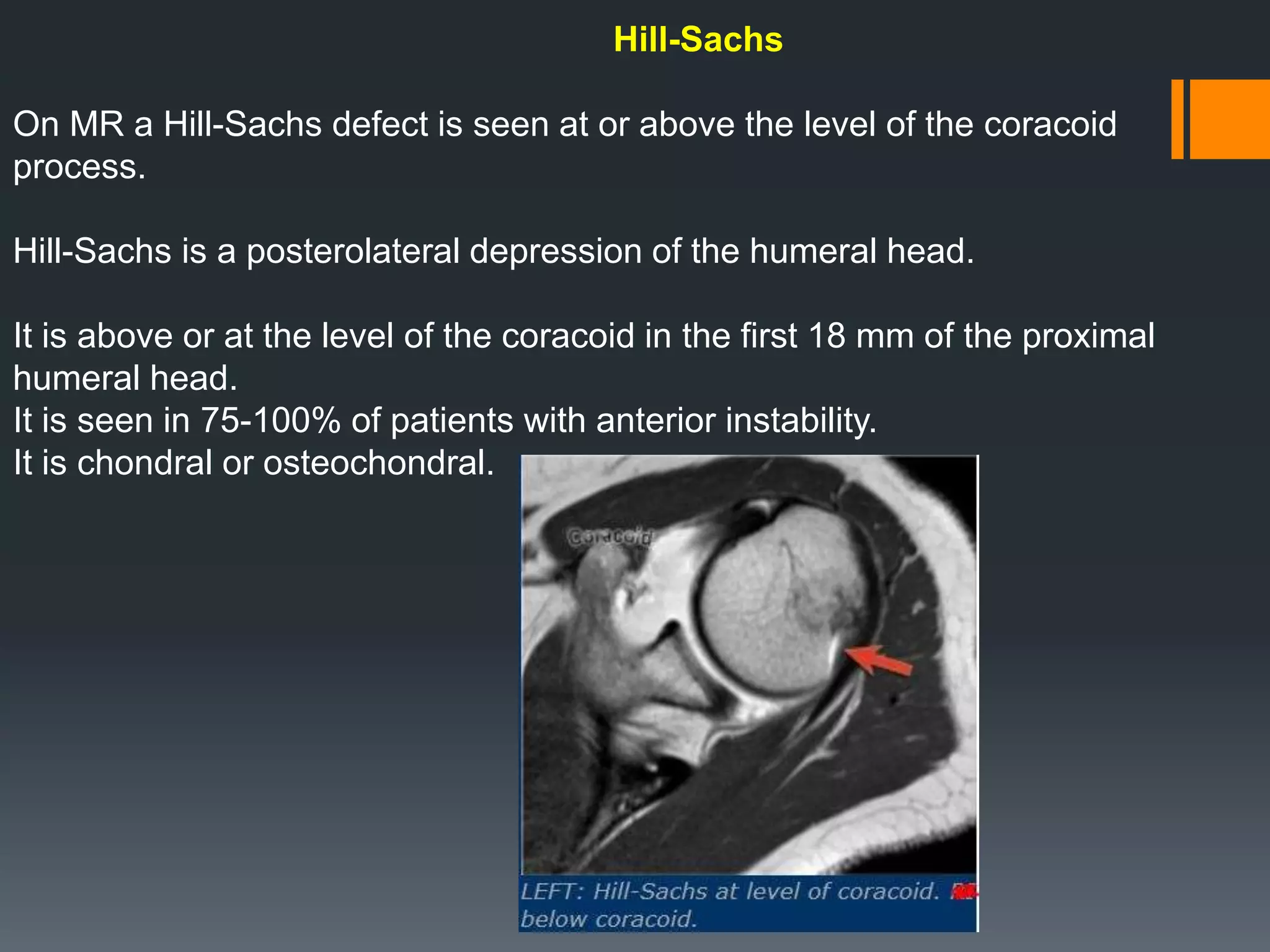 Hill-Sachs
On MR a Hill-Sachs defect is seen at or above the level of the coracoid
process.
Hill-Sachs is a posterolateral depression of the humeral head.
It is above or at the level of the coracoid in the first 18 mm of the proximal
humeral head.
It is seen in 75-100% of patients with anterior instability.
It is chondral or osteochondral.
 