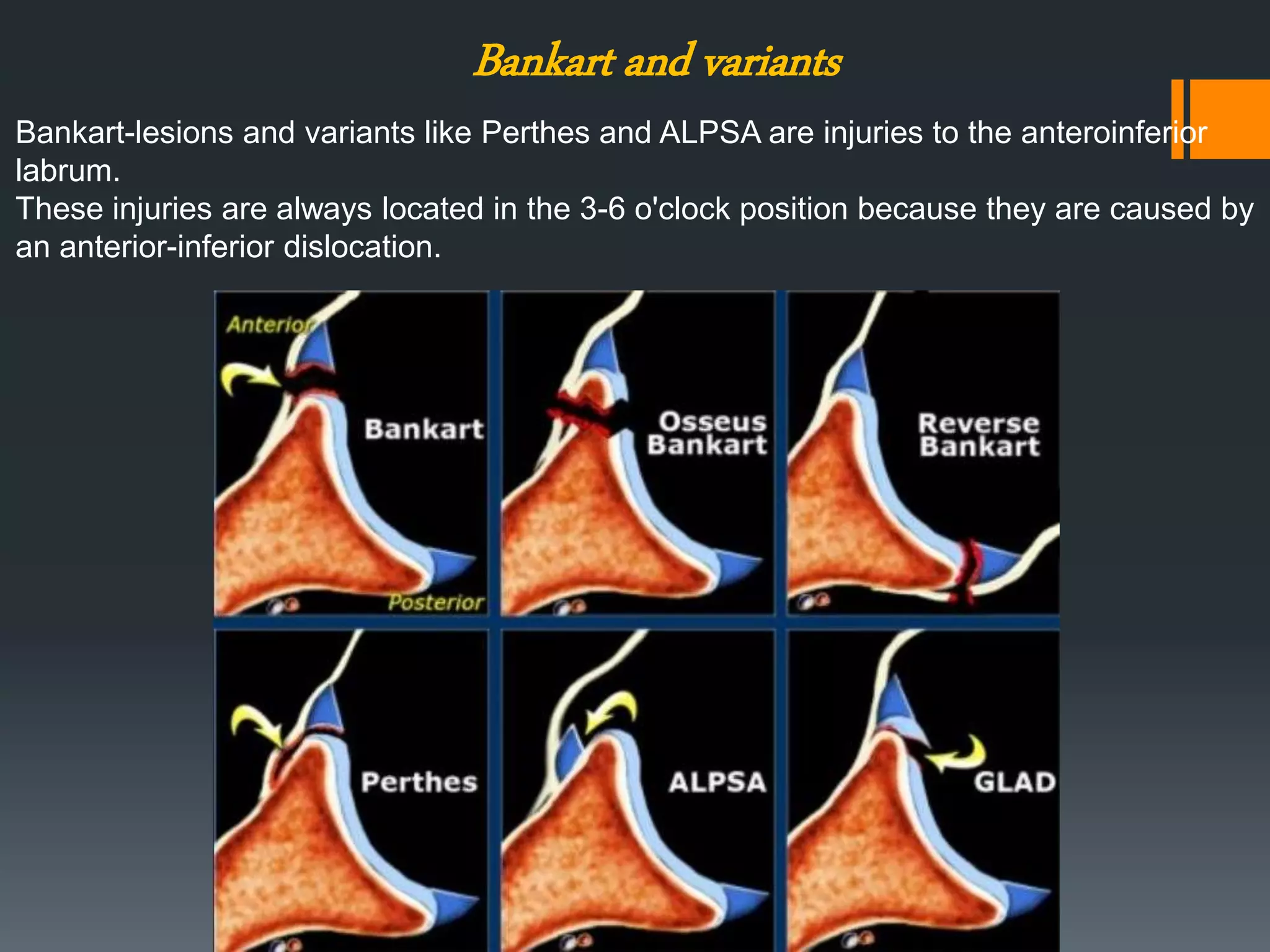Bankart and variants
Bankart-lesions and variants like Perthes and ALPSA are injuries to the anteroinferior
labrum.
These injuries are always located in the 3-6 o'clock position because they are caused by
an anterior-inferior dislocation.
 