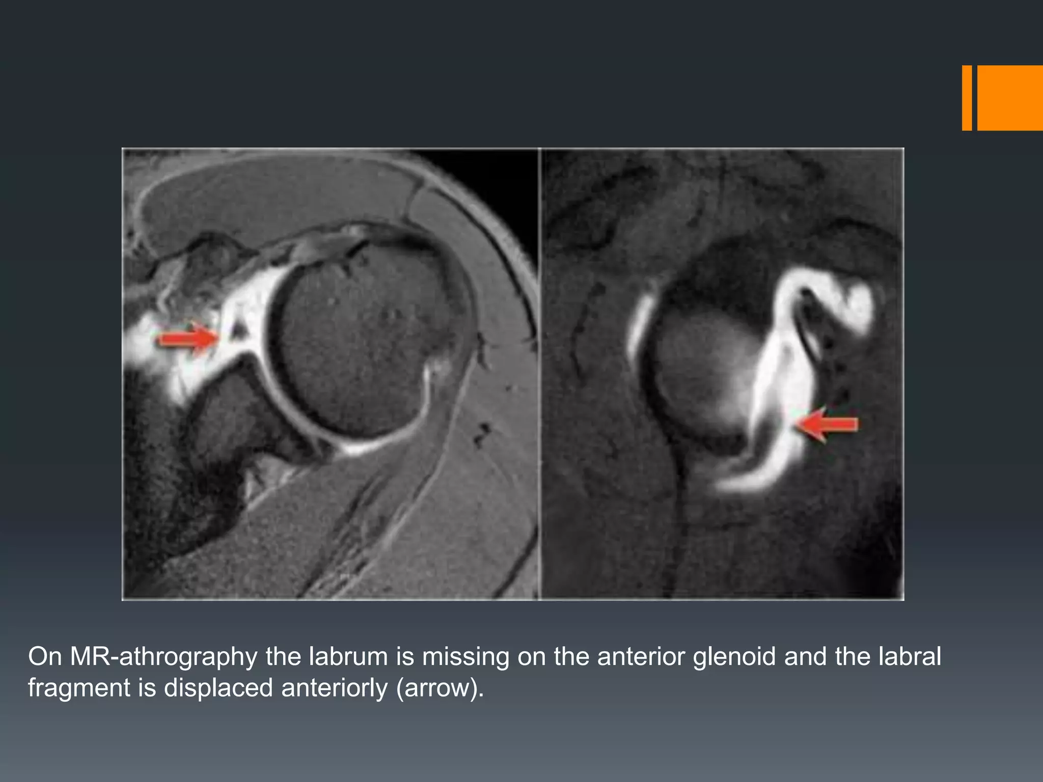 On MR-athrography the labrum is missing on the anterior glenoid and the labral
fragment is displaced anteriorly (arrow).
 